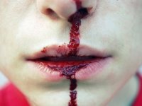 Кровь из носа: причины у взрослого при нормальном давлении
