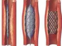 Что такое кардиосклероз атеросклероз аорты коронарных артерий?