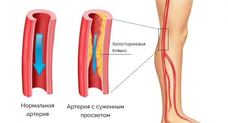 Смотреть Гипертония 2 степени – что это такое, симптомы и лечение. Как снизить артериальное давление при гипертонической болезни видео Смотреть Гипертония 2 степени – что это такое, симптомы и лечение. Как снизить артериальное давление при гипертонической болезни видео