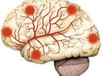 Как лечить атеросклероз сосудов головного мозга в домашних условиях?
