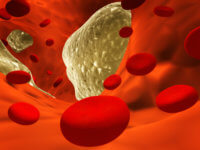Нестенозирующий атеросклероз брахиоцефальных артерий: что это такое?
