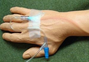 Флебит (воспаление) вены на руке: лечение